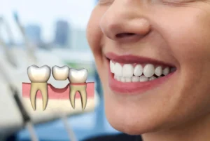 Woman smiling with healthy teeth and a detailed diagram illustrating a dental bridge anchored to adjacent teeth.